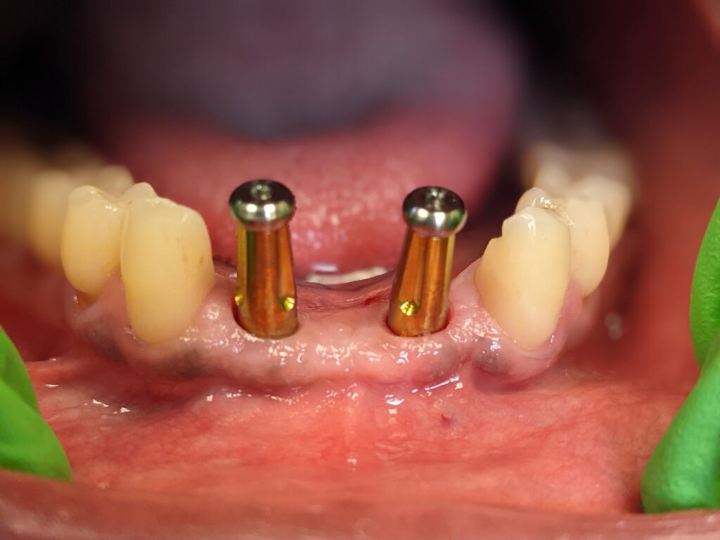 Dental Implant - Elite Dental Summerfield