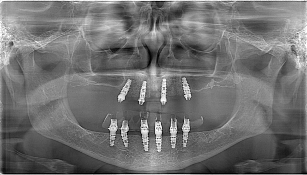 Transform Your Smile with Implant Dentures at Elite Dental of Summerfield
